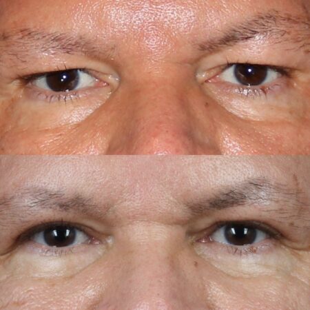 Upper blepharoplasty to treat eyelid hooding by Dr. Miller