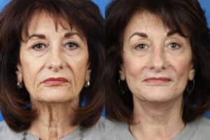 facelift results in NYC, NY