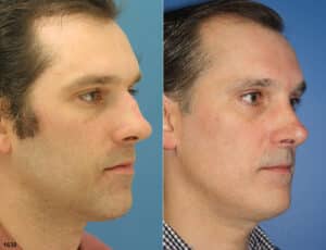 male rhinoplasty results in NYC