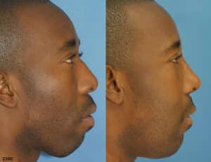 male nose job results in NY, NY