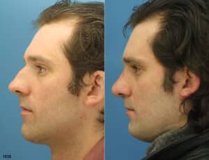 rhinoplasty before and after image of male NYC patient