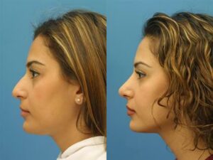 Image showing a female patient of Dr. Miller before and after the rhinoplasty improving nasal contours and physical appearance