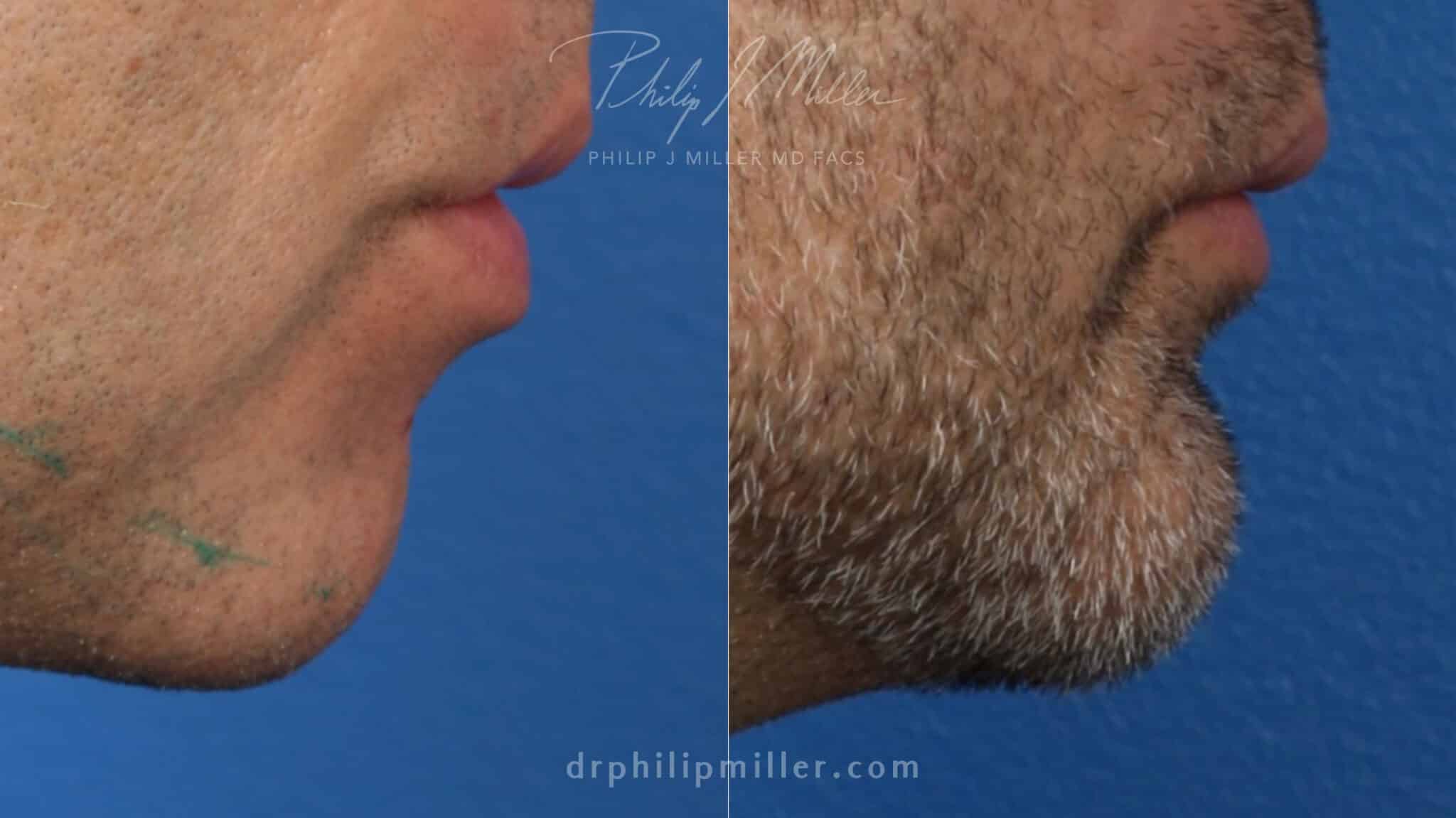 Chin implant to add fullness and definition to the chin by Dr. Miller. After surgery, chin is proportionate to the mouth to create a more aesthetically-pleasing facial profile.