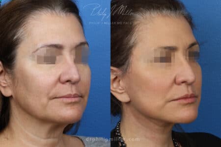 NatraNeck and NatraLift to rejuvenate the neck and lower face, 2 months post-op, by Dr. Miller