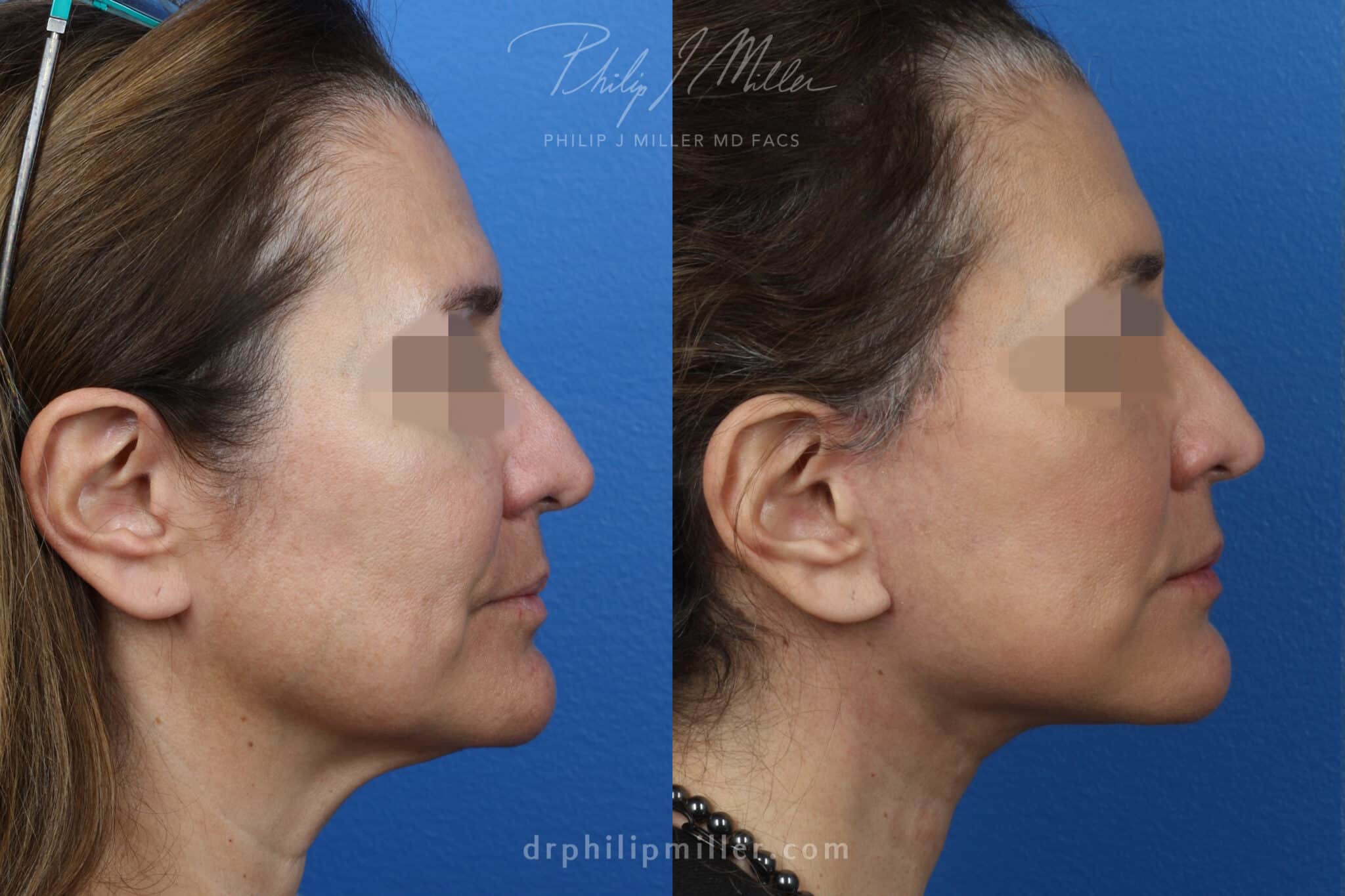 NatraNeck and NatraLift to rejuvenate the lower face by Dr. Miller. Surgery removes early jowl formation and enhances definition of the neck and jawline.