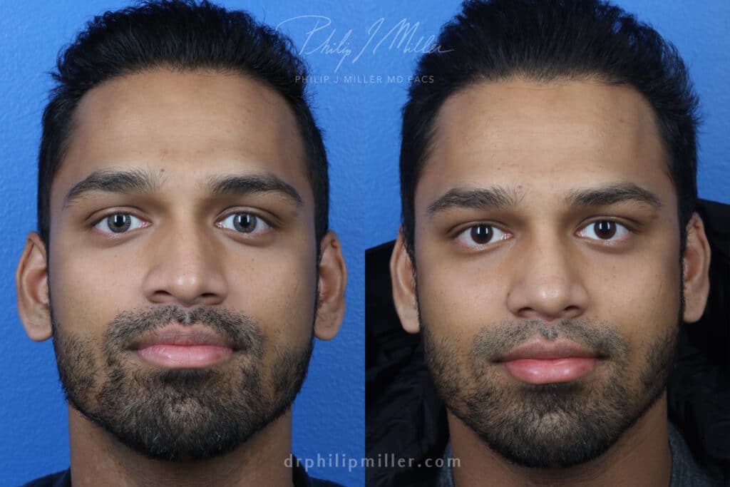 Rhinoplasty to straighten nose and refine the nasal tip of a male patient by Dr. Miller. Surgery improves nasal bridge and refines the nasal tip to improve the patient's facial profile.