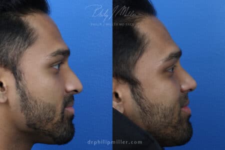 Rhinoplasty to straighten nose and refine tip by Dr. Miller