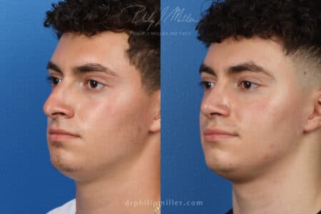 Rhinoplasty to correct bridge and nasal tip, 3 months post-op, by Dr. Miller