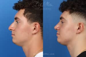 Rhinoplasty to correct the nasal bridge and tip by Dr. Miller. After surgery, tip is rotated and bridge is straightened to produce a better profile.