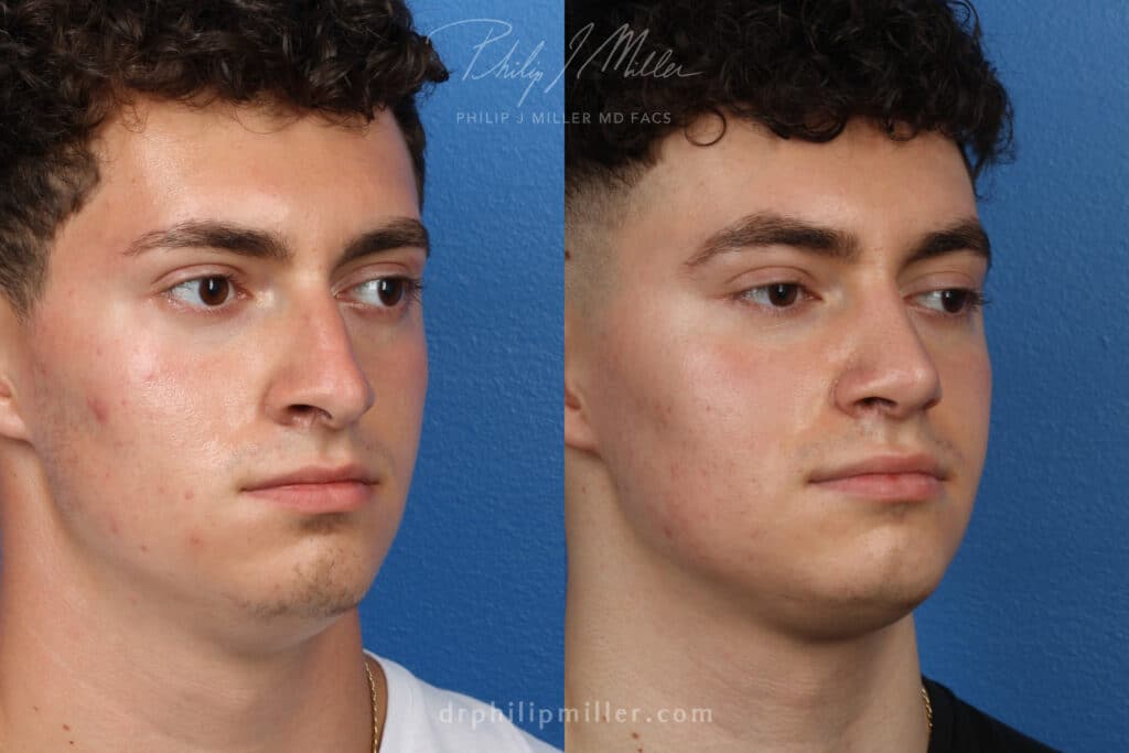 Rhinoplasty to correct the nasal bridge and tip by Dr. Miller. After surgery, tip is rotated and bridge is straightened to produce a better profile.