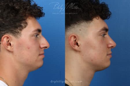 Rhinoplasty to correct bridge and nasal tip, 3 months post-op, by Dr. Miller