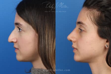 Rhinoplasty to enhance nose – 1 week post-op by Dr. Miller