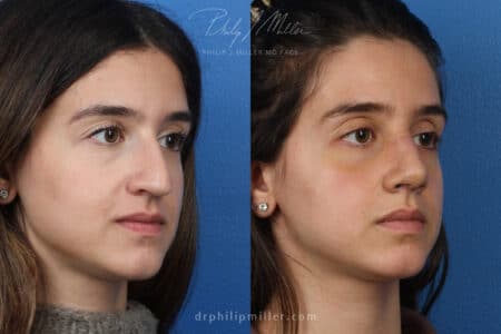 Rhinoplasty to enhance nose – 1 week post-op by Dr. Miller