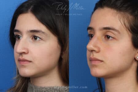 Rhinoplasty to enhance nose – 1 week post-op by Dr. Miller