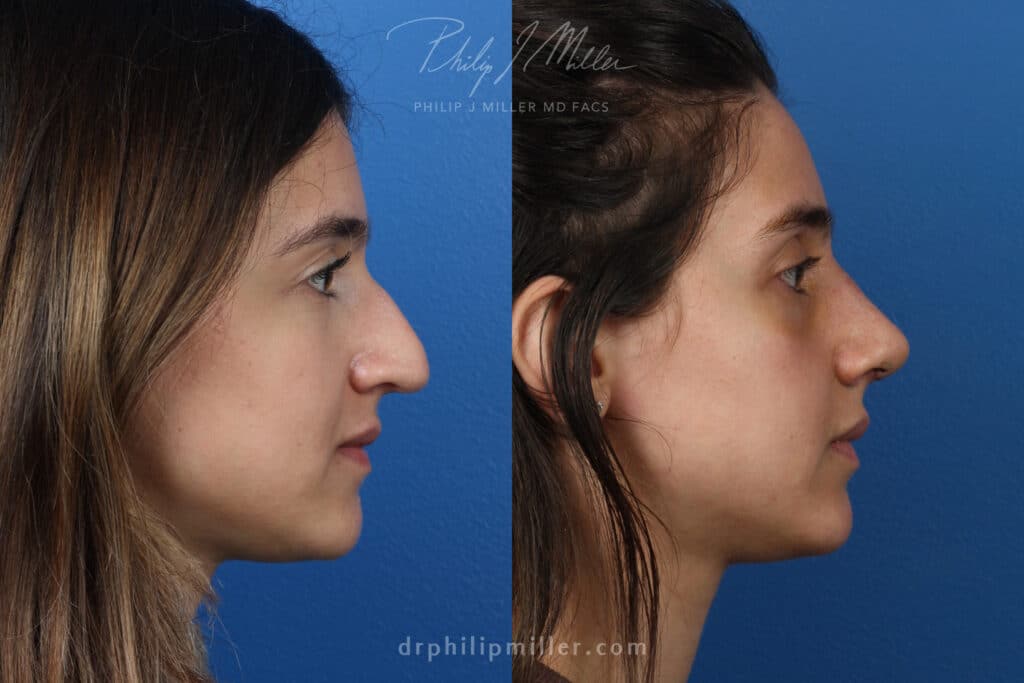 Rhinoplasty to enhance noses one week post-op. After surgery nasal tip is rotated and bridge is straightened to improve facial profile.