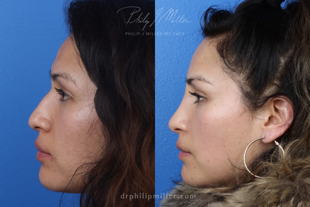 Rhinoplasty to correct nasal bridge and tip by Dr. Miller. After surgery, hump is removed from nasal bridge and tip is more refined.