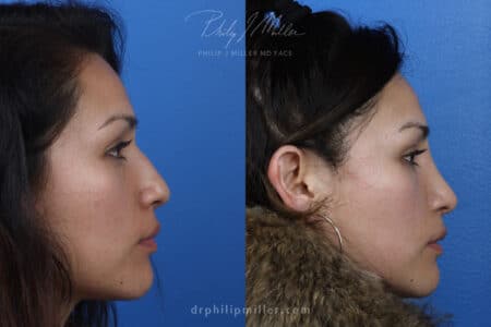 Rhinoplasty to remove hump from nasal bridge and refine tip by Dr. Miller