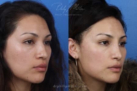 Rhinoplasty to remove hump from nasal bridge and refine tip by Dr. Miller