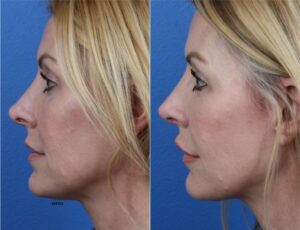 rhinoplasty results on patient with realistic rhinoplasty expectations in NY, NY