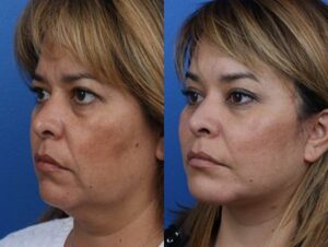 surgical facelift results in NYC, NY