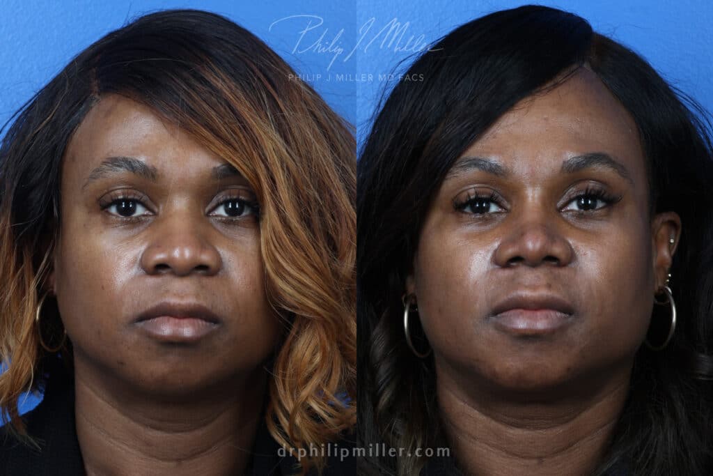 Rhinoplasty to refine the nasal bridge, 3 months post-op, by Dr. Miller. After surgery, bridge is straighter and tip is refined to improve the facial profile.