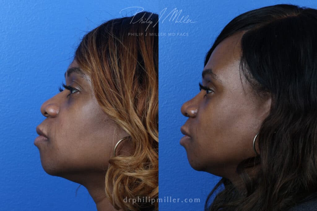 Rhinoplasty to refine the nasal bridge, 3 months post-op, by Dr. Miller. After surgery, bridge is straighter and tip is refined to improve the facial profile.