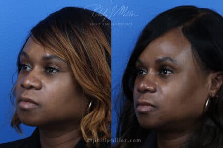 Rhinoplasty to refine the nasal bridge, 3 months post-op, by Dr. Miller