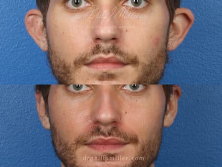 Otoplasty to correct the ear position of a male patient by Dr. Miller