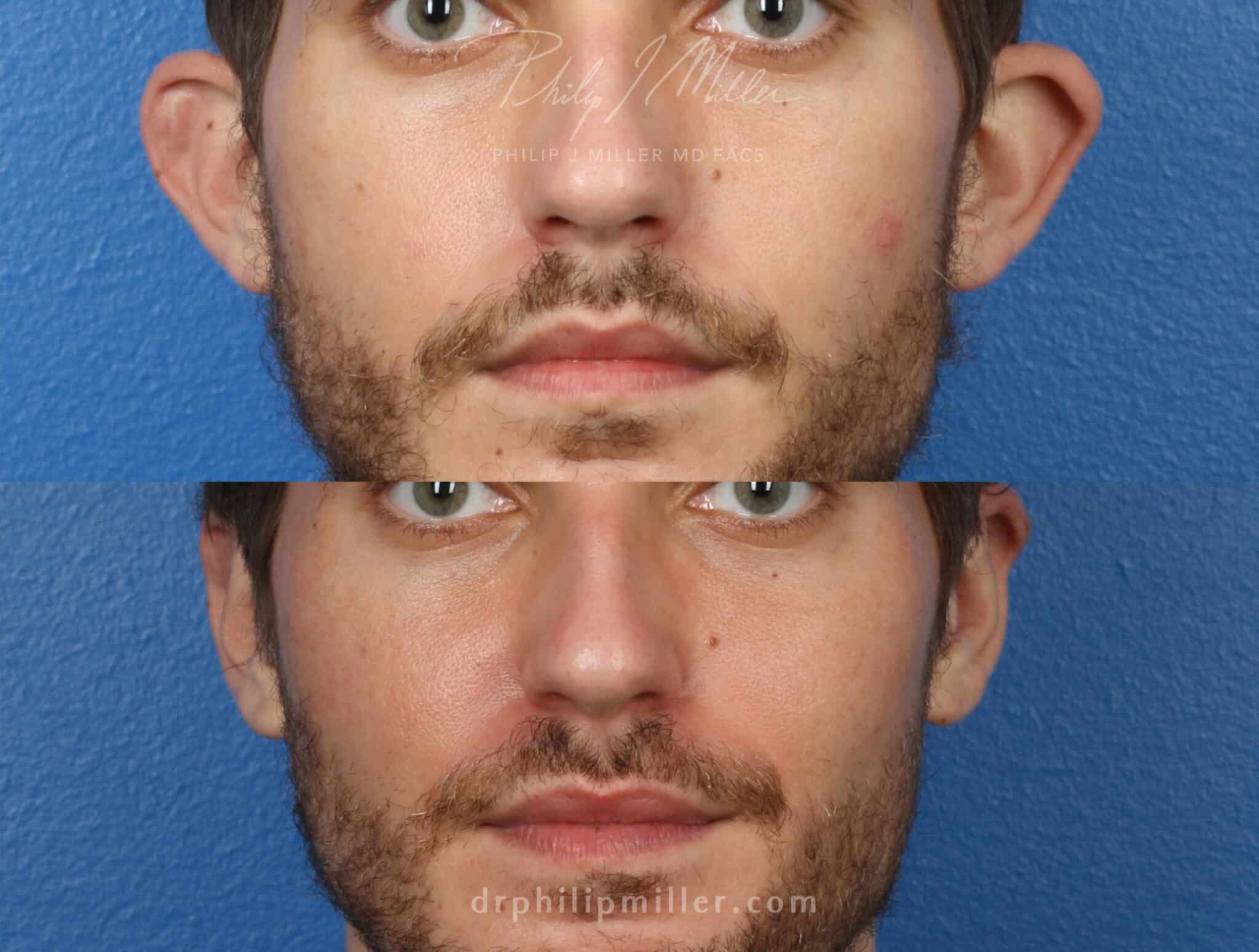 Otoplasty to correct the ear position of a male patient by Dr. Miller. After surgery, ears are positioned closer to the head for a more aesthetically-pleasing facial contour.