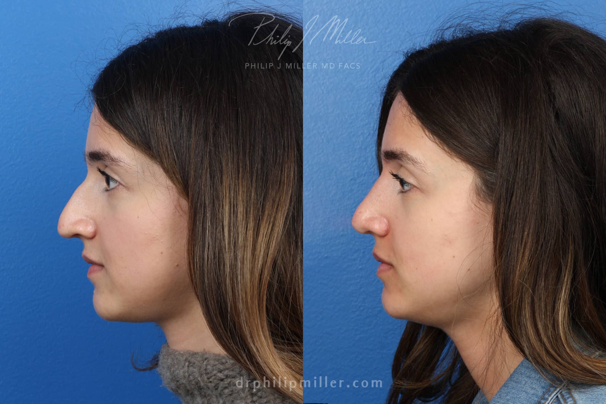 Rhinoplasty to enhance nose three months post-op by Dr. Miller. Surgery straightens bridge and creates a more aesthetically-pleasing facial profile.
