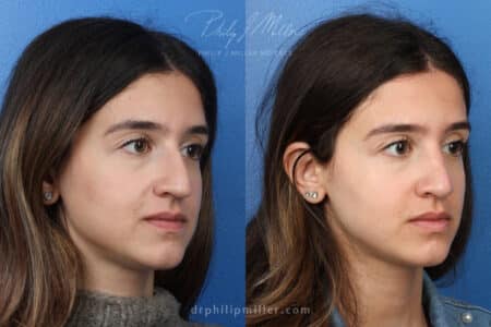 Rhinoplasty to enhance nose three months post-op by Dr. Miller.