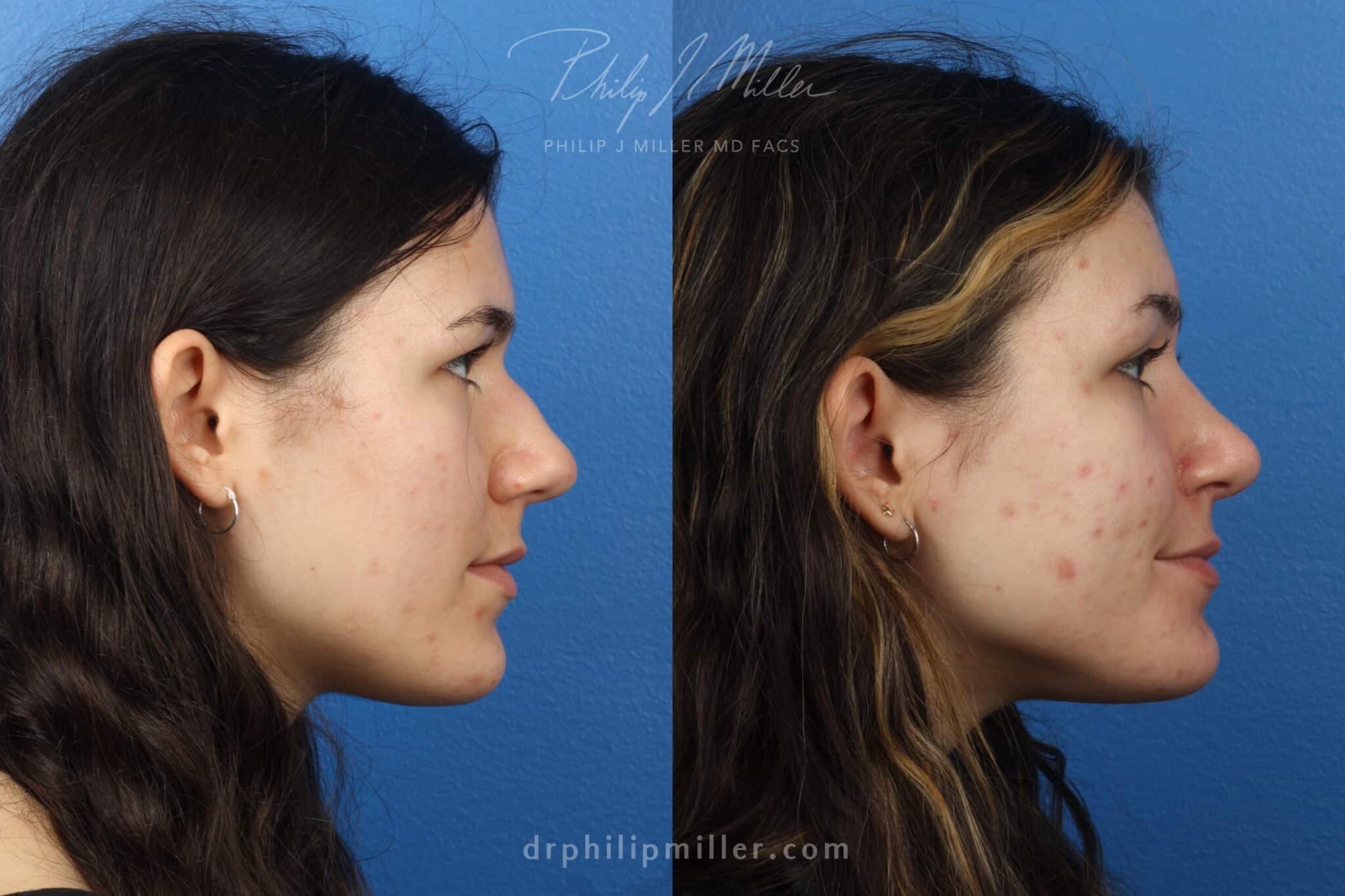 Rhinoplasty to improve the appearance of the nose, one week post-op, by Dr. Miller. After surgery, hump is gone and nose is slightly upturned for a more pleasing facial profile.