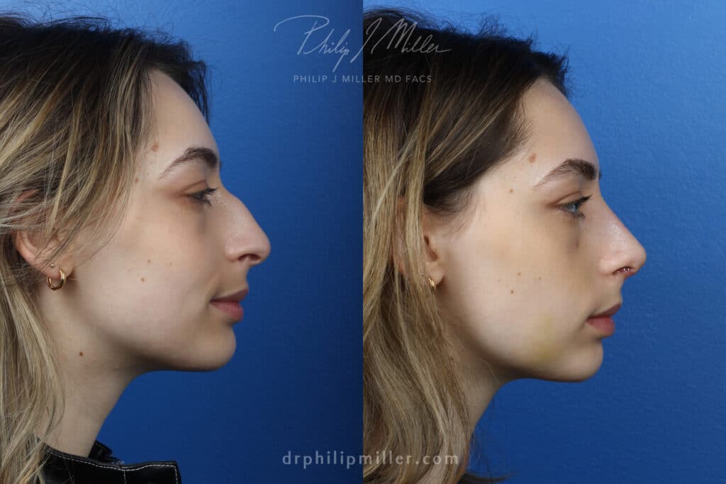 Rhinoplasty to improve the nasal bridge, one week post-op, by Dr. Miller. Surgery straightens bridge and rotates nasal tip for a more attractive profile.