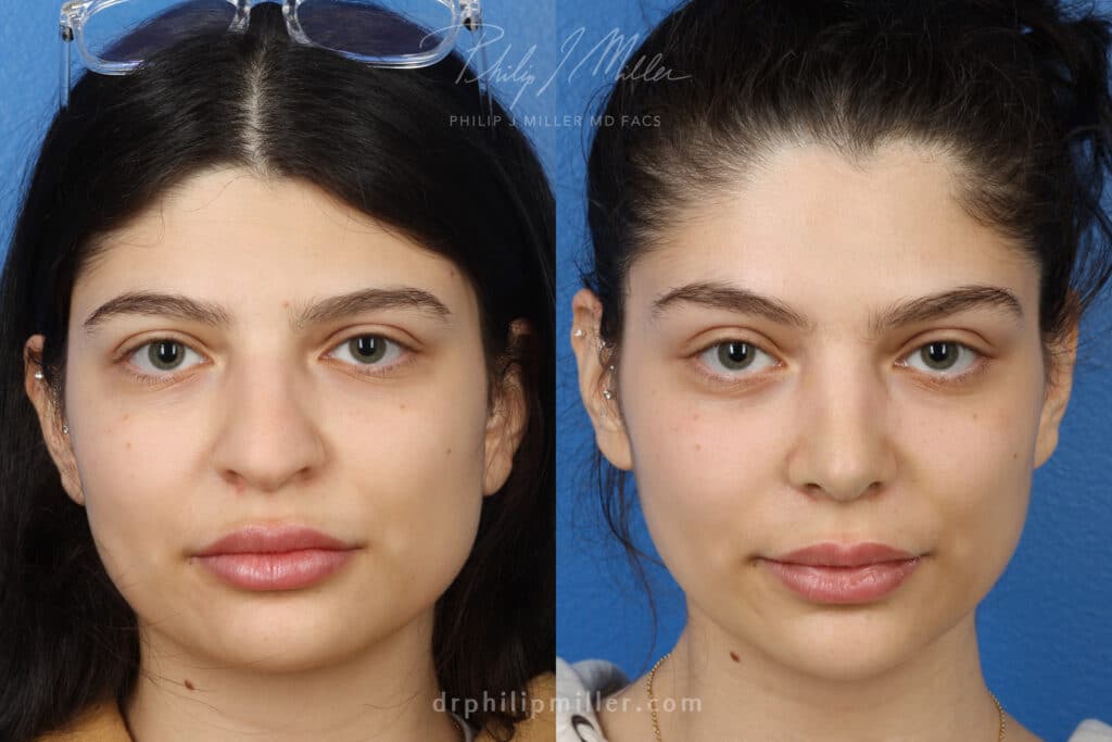 Rhinoplasty to enhance appearance of nose, one week post-op, by Dr. Miller. Surgery narrows and straighten bridge for more aesthetically-pleasing facial contour.