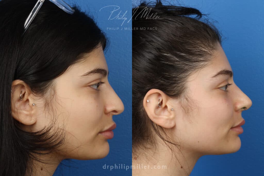 Rhinoplasty to enhance appearance of nose, one week post-op, by Dr. Miller. Surgery narrows and straighten bridge for more aesthetically-pleasing facial contour.