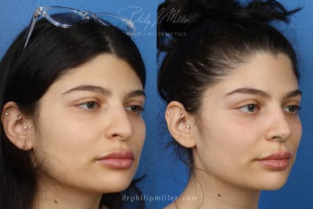 Rhinoplasty to enhance appearance of nose, one week post-op, by Dr. Miller