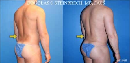 Body banking to treat Poland Syndrome by Dr. Steinbrech