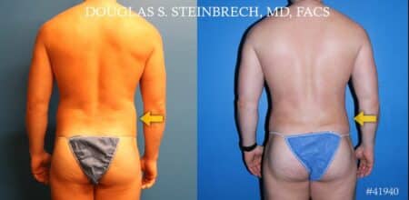 Body banking to treat Poland Syndrome by Dr. Steinbrech