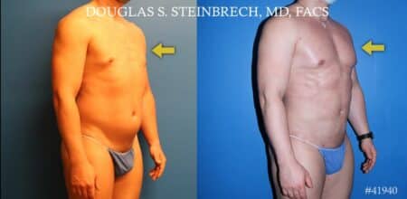 Body banking to treat Poland Syndrome by Dr. Steinbrech