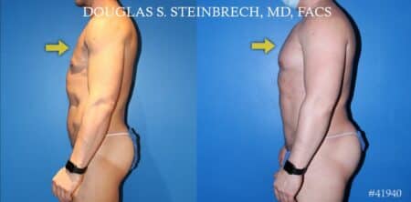 Body banking to treat Poland Syndrome by Dr. Steinbrech