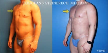 Body banking to treat Poland Syndrome by Dr. Steinbrech