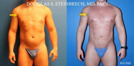 Body banking to treat Poland Syndrome by Dr. Steinbrech