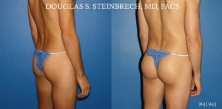 Gluteal augmentation to enhance the buttocks by Dr. Steinbrech