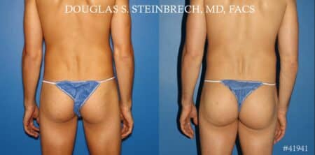 Gluteal augmentation to enhance the buttocks by Dr. Steinbrech