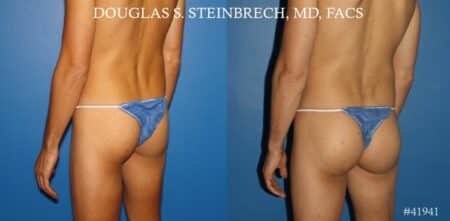 Gluteal augmentation to enhance the buttocks by Dr. Steinbrech