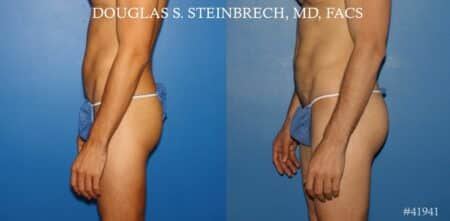 Gluteal augmentation to enhance the buttocks by Dr. Steinbrech
