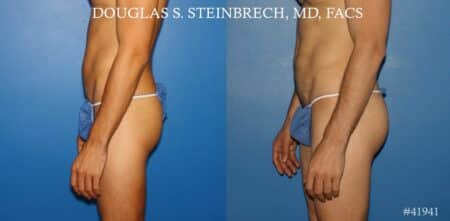 Gluteal augmentation to enhance the buttocks by Dr. Steinbrech