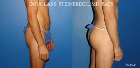 Gluteal augmentation to enhance the buttocks by Dr. Steinbrech