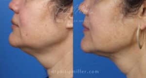 MyEllevate treatment to rejuvenate the lower face and jawline by Dr. Miller. Treatment removes loose skin under chin and creates a more defined jawline.