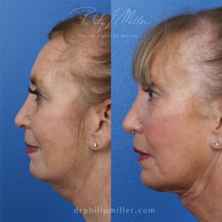 MyEllevate treatment to rejuvenate the lower face, by Dr. Miller